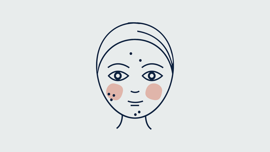 ilustracion de una persona con acne en el rostro
